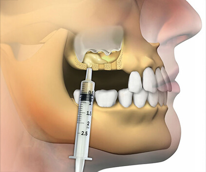 Sinus Yükseltme